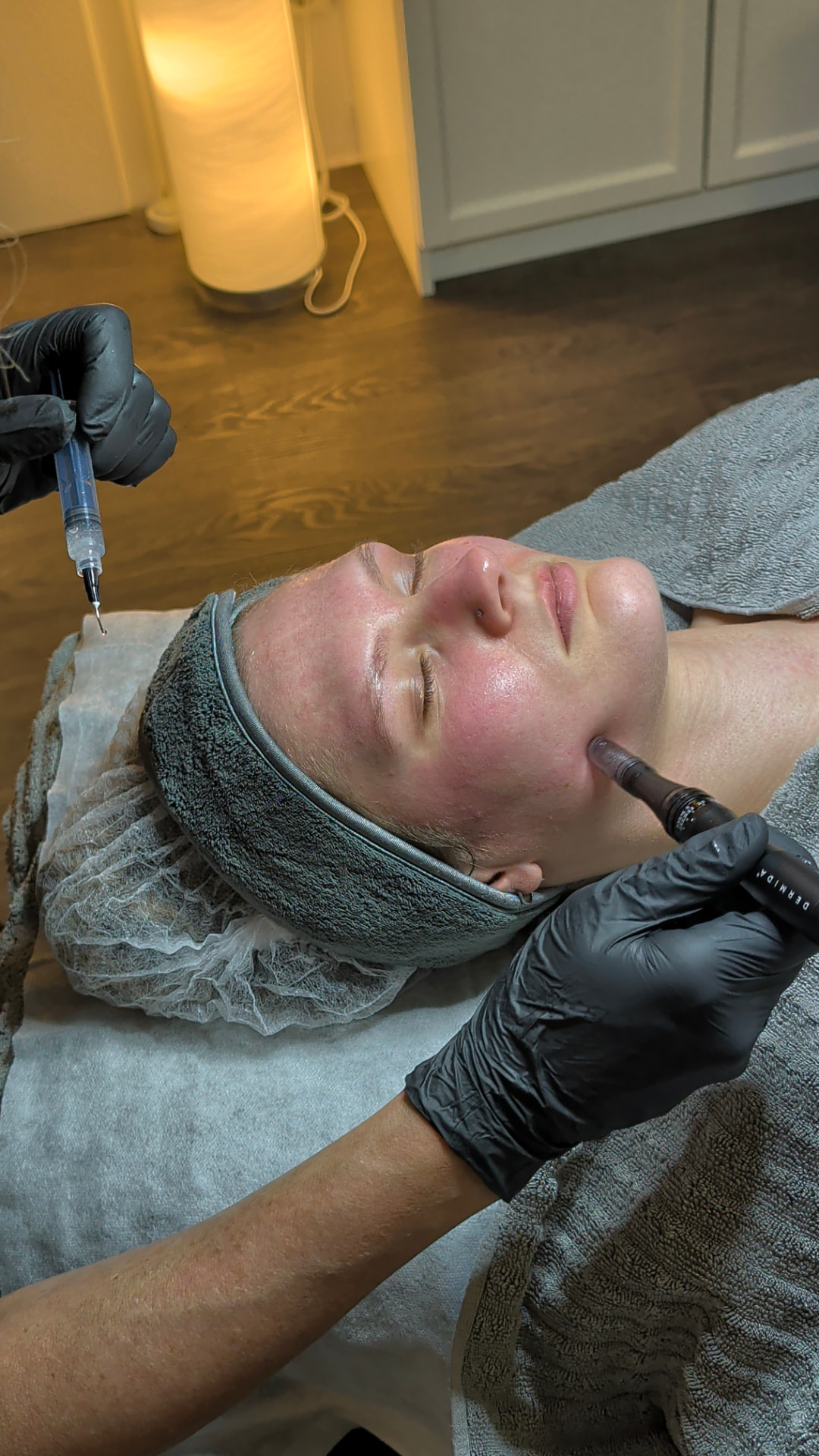 Microneedling-Behandlung bei Omnia Sentira